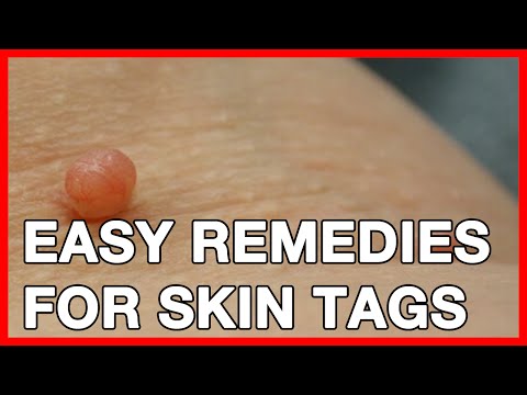 Easy Home Remedies For Skin Tags