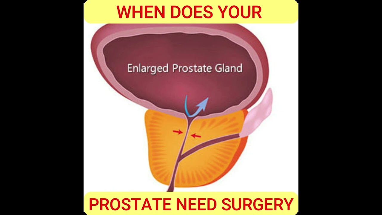WHEN DOES YOUR PROSTATE NEED SURGERY 