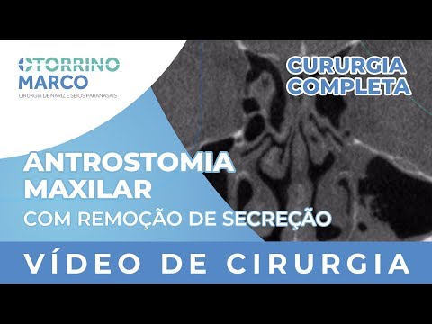 Vídeo de Cirurgia: Antrostomia Maxilar Com Remoção de Secreção - Otorrino Marco