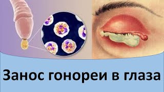 Занос гонококка в глаза