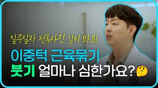 이중턱 지방흡입 및 근육묶기 많이 붓나요? │ #이중턱 #이중턱수술 #이중턱지방흡입 #이중턱근육묶기 #지방흡입 #근육묶기 #성형외과