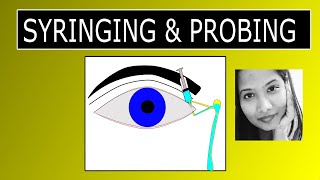 Lacrimal Syringing & Probing | Procedure & Interpretation of Results screenshot 4