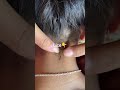 liceinfestation709 #headliceremoval #licecomb #headlice #headlicetreatment #hairlice #haircare #hair