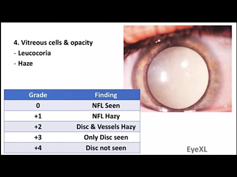 Video: Intermediate Uveitis: Muster Von Ätiologie, Komplikationen, Behandlung Und Ergebnis In Einem Tertiären Akademischen Zentrum