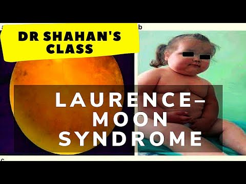 Laurence–Moon syndrome | Dr Shahan&rsquo;s Class ☺️