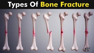 Common Types OF Bone Fracture/3D Animation/Urdu/Hindi/bones Bonefractureanimation biology