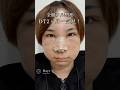 【全顔フル整形】ダウンタイム一気見!#shorts