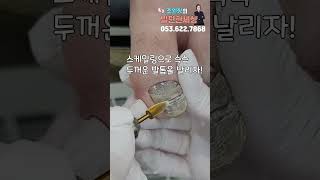 발톱은 소중합니다ㅠㅠ #shorts #소중한 #대구내성발톱  #대구무좀 #대구발톱 #ingrown #toenails