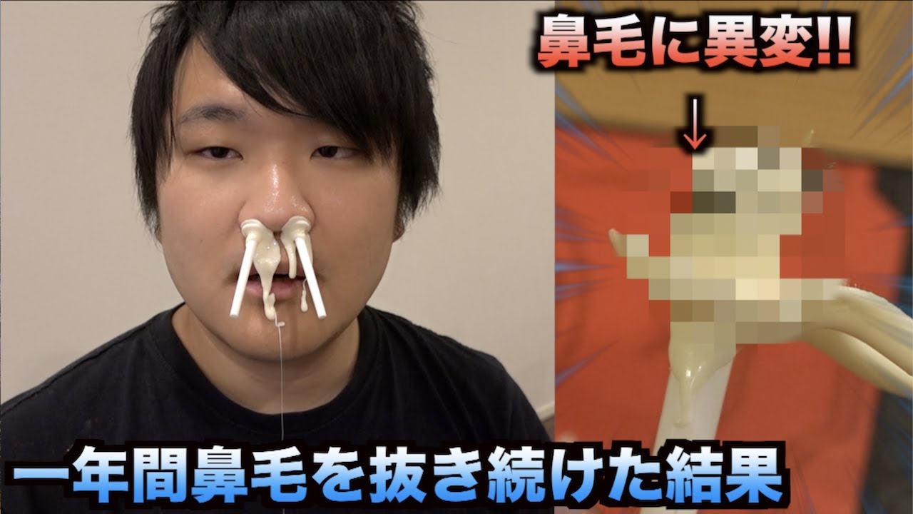 一年間鼻毛を脱毛し続けたら鼻毛が突然変異を起こしたんだけどwwwww Youtube