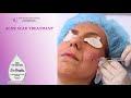 Prp and fraxel laser for acne scars in santa monica