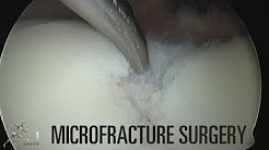 Cartilage injury: Microfracture surgery