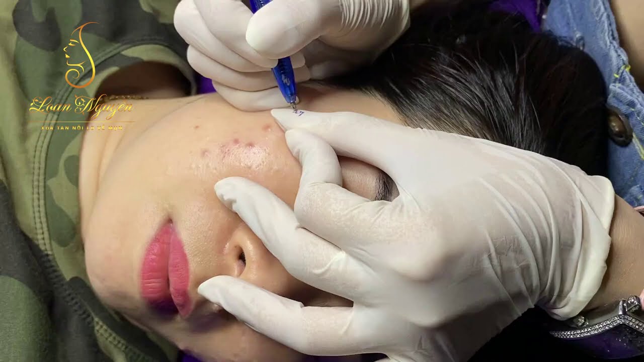 Blackheads extraction and pimple poping (348) | Loan Nguyen