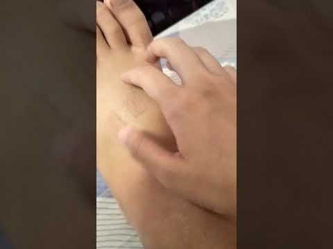 埋針😱腳踝扭到