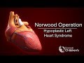 Medical animation norwood operation  cincinnati childrens