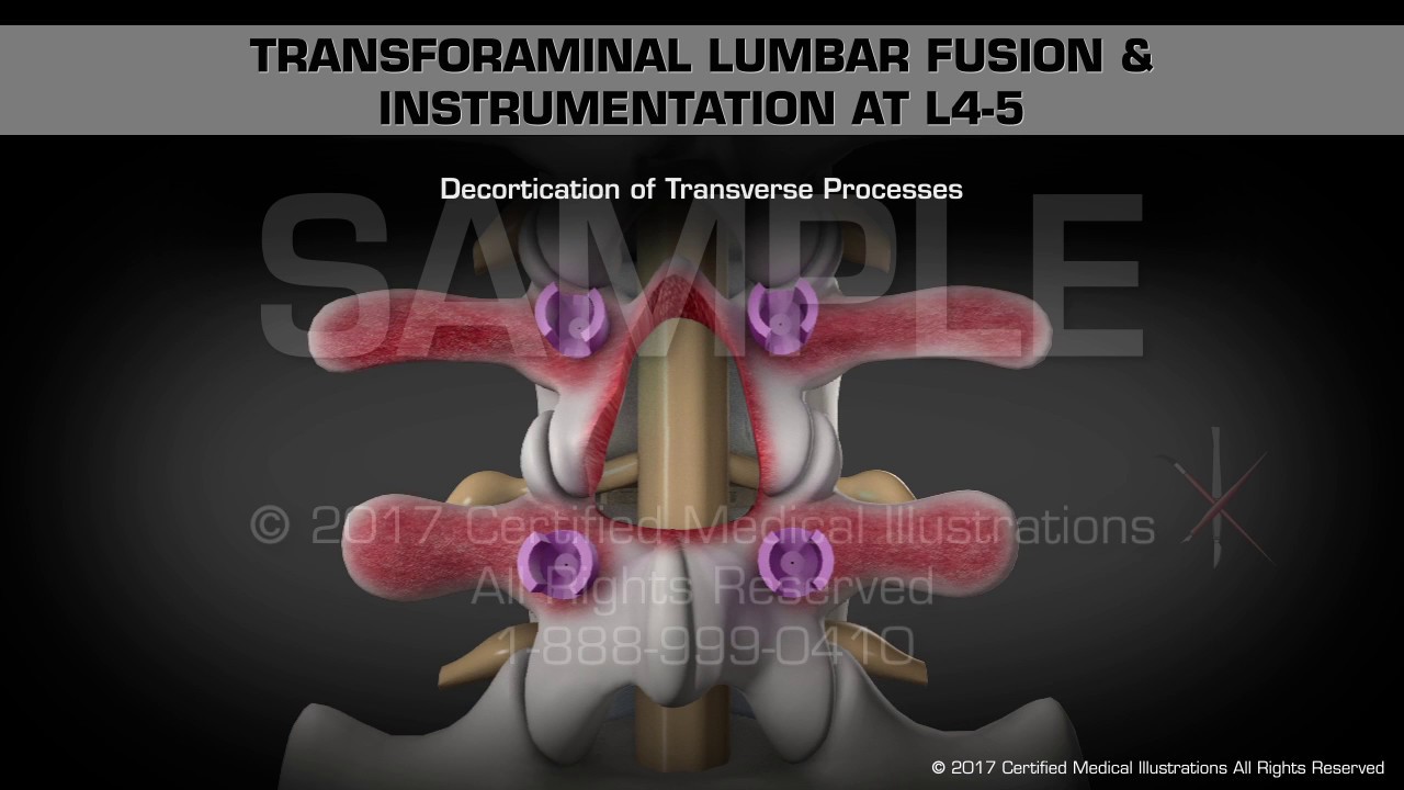 Transforaminal Lumbar Fusion & Instrumentation at L4-5 video phone é a continuação de telephone