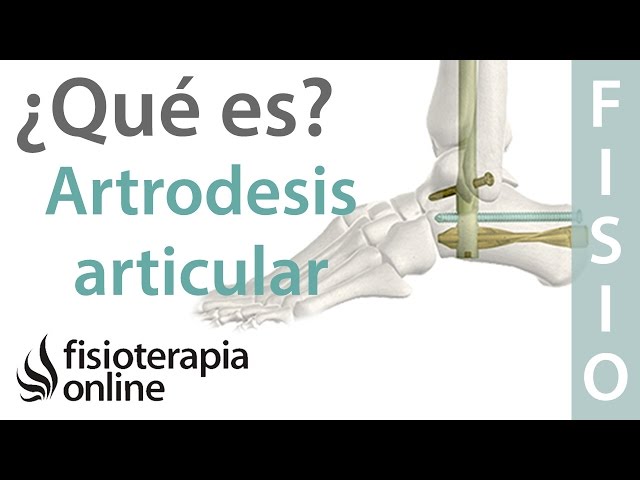 artrodesis definicion