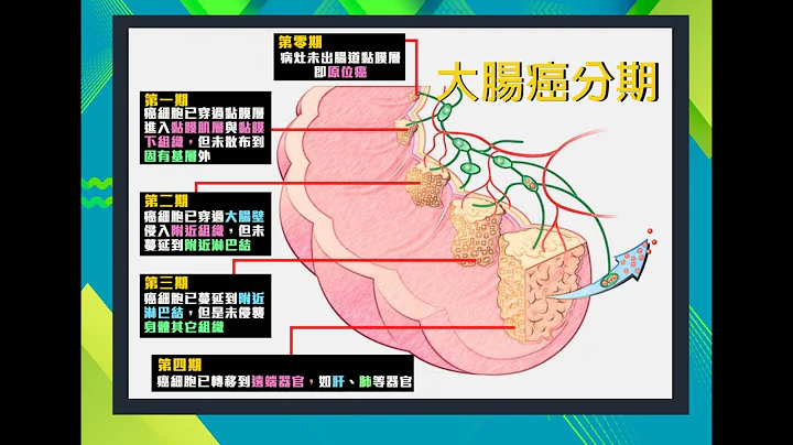 【名醫妙方】大腸癌的分期與其治療方式 2022.07.25 - 天天要聞