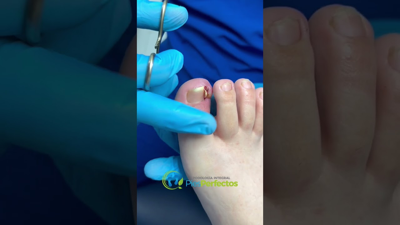 ¿Cuáles son los síntomas de uñas encarnadas y cuándo debería buscar ayuda médica en un centro podológico en Móstoles?