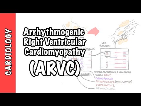 Arrhythmogenic right ventricular cardiomyopathy (ARVC) - pathophysiology, investigations, treatment