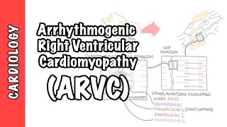 Arrhythmogenic right ventricular cardiomyopathy (ARVC)  pathophysiology, investigations, treatment