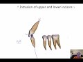 Pure intrusion of lower incisors