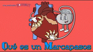 Qué es un Marcapasos, Marcapasos sin Cables, Resincronización Cardíaca