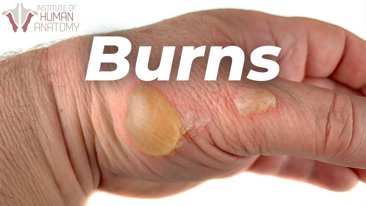 Skin Burns A LOT Faster Than You Think