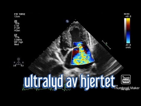 Video: Stress Ekkokardiografi: Formål, Procedure Og Resultater