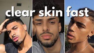 how to ACTUALLY get clear skin for men | 6 simple steps