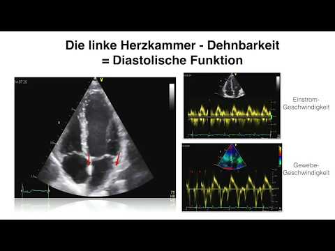 Video: Echokardiographische Beurteilung Der Ischämischen Mitralinsuffizienz