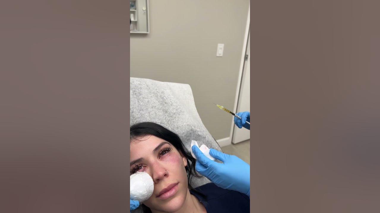 Prf under eyes injections by rn stephanie ageless md youtube