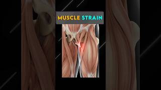 Private Part me Dard | पेट के नीचे दर्द | Inguinal Pain | #inguinal pain