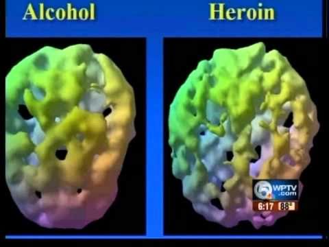 Brain scans fight addiction - YouTube