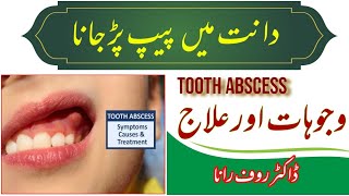 TOOTH ABSCESS DENTAL INFECTION, Dental abscess - causes symptoms diagnosis, treatment  in Urdu/Hindi