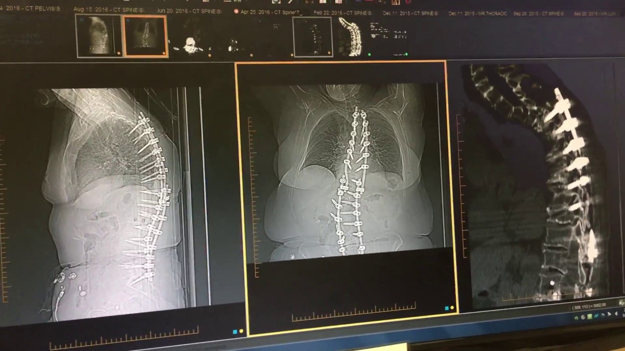 How much does spinal fusion limit mobility Not much YouTube