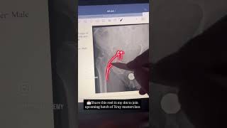 Hip Xray Clinical Tip On Shenton Line