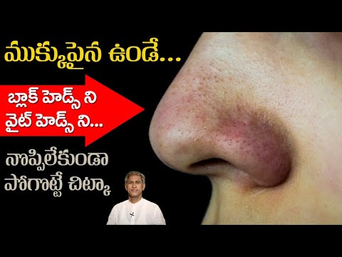 Home Depot Whitemarsh - How to Remove Blackheads Permanently | DIY Pack to Get Spotless Skin | Dr. Manthena's Beauty Tips