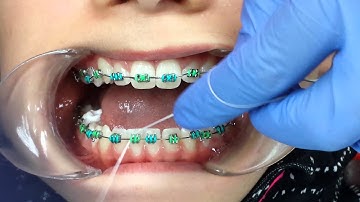 Flossing teeth with braces using a floss threader