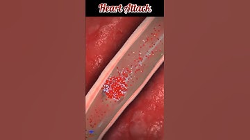 What is heart attack ? #heartattack #heart