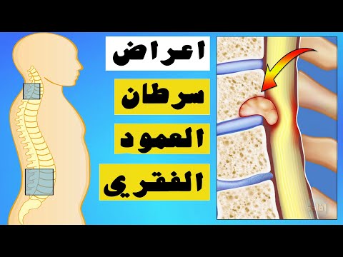 فيديو: هل الورم الوعائي الكرز سرطاني؟