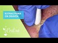 Blackhead extractions with draven