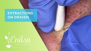 Blackhead Extractions With Draven