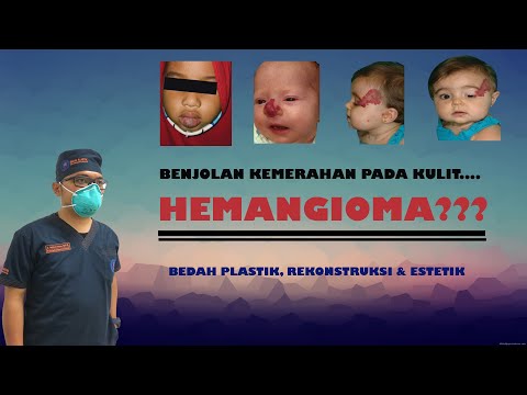 Video: Hemangioma - Daftar Istilah Medis