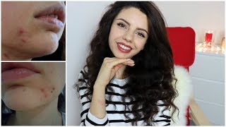КАК ИЗБАВИТЬСЯ ОТ ПРЫЩЕЙ И ПОСТАКНЕ👊МОЕ ПИТАНИЕ И УХОД🍎 КАК ИЗБАВИТЬСЯ ОТ ПРЫЩЕЙ И ПОСТАКНЕ👊МОЕ ПИТАНИЕ И УХОД🍎