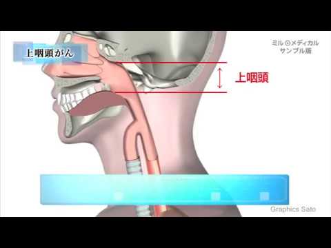 咽頭がん／ミルメディカル　家庭の医学動画版