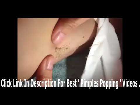 Best Biggest Pimple Pop Ever , Removal Cyst at home