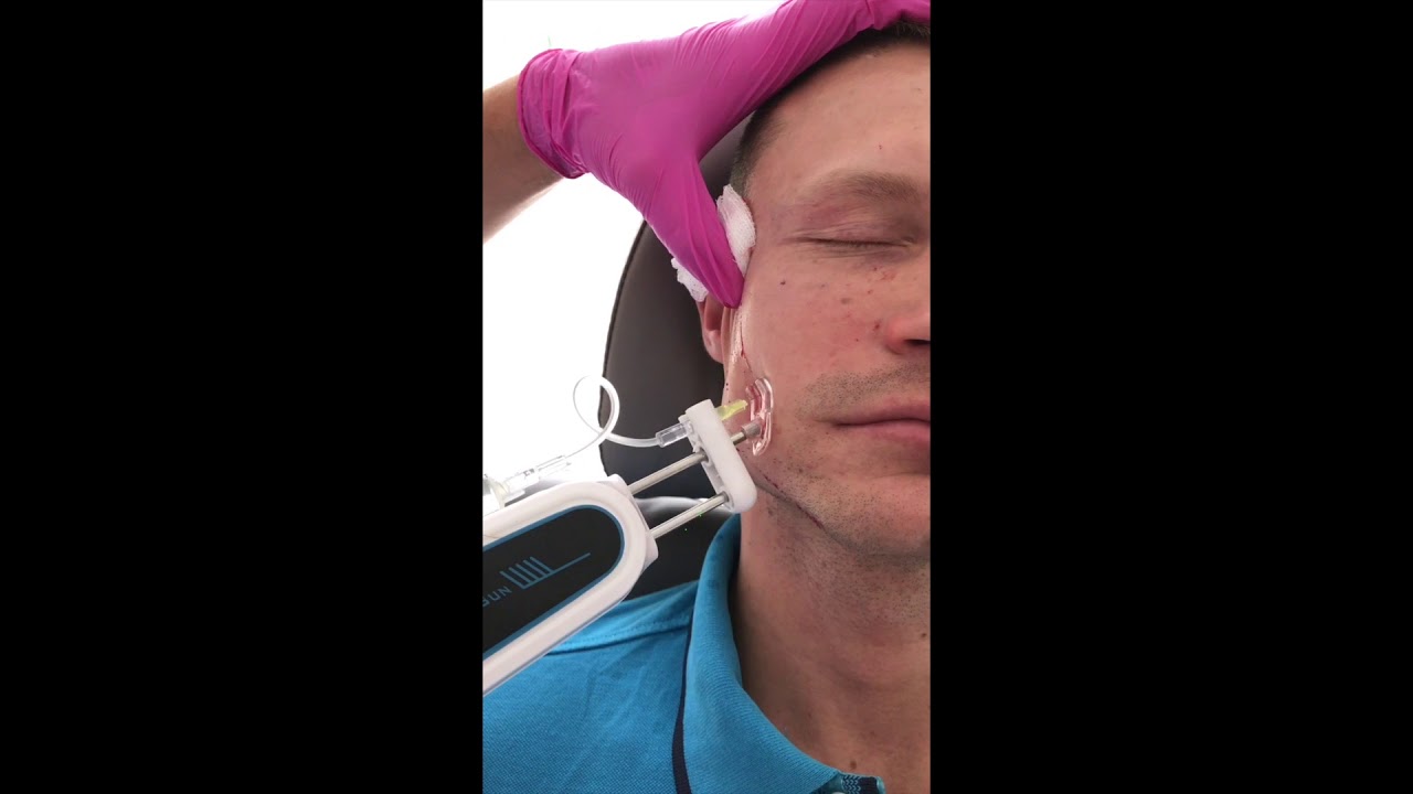 Mezogun czyli Mezoterapia igłowa