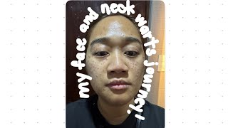  My Face And Neck Painless  Warts Removal Journey
