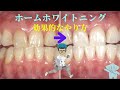 ホームホワイトニングの効果的なやり方