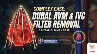 Complex Case: Dural AVM &amp; IVC Filter Removal | 62-Year-Old Patient | Neuro Interventional Radiology